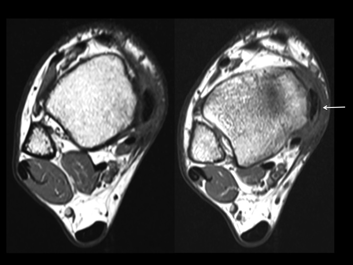 Figure 3 for case flexor retinaculum ( RID2313 )